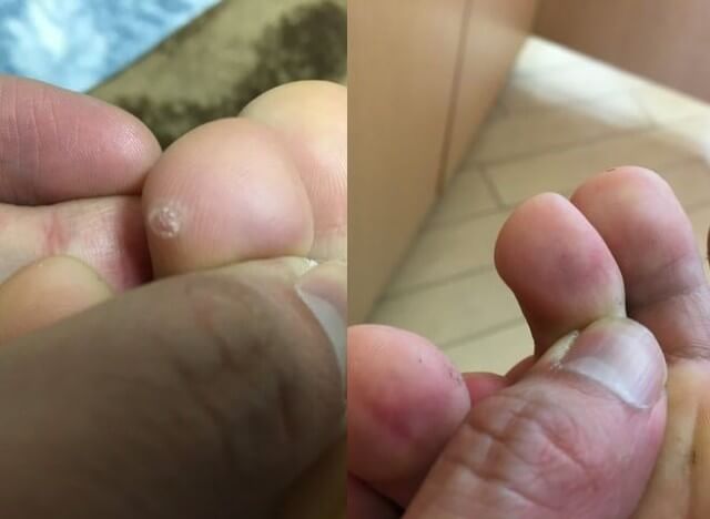 美しい花の画像 最高子供 指 イボ 原因